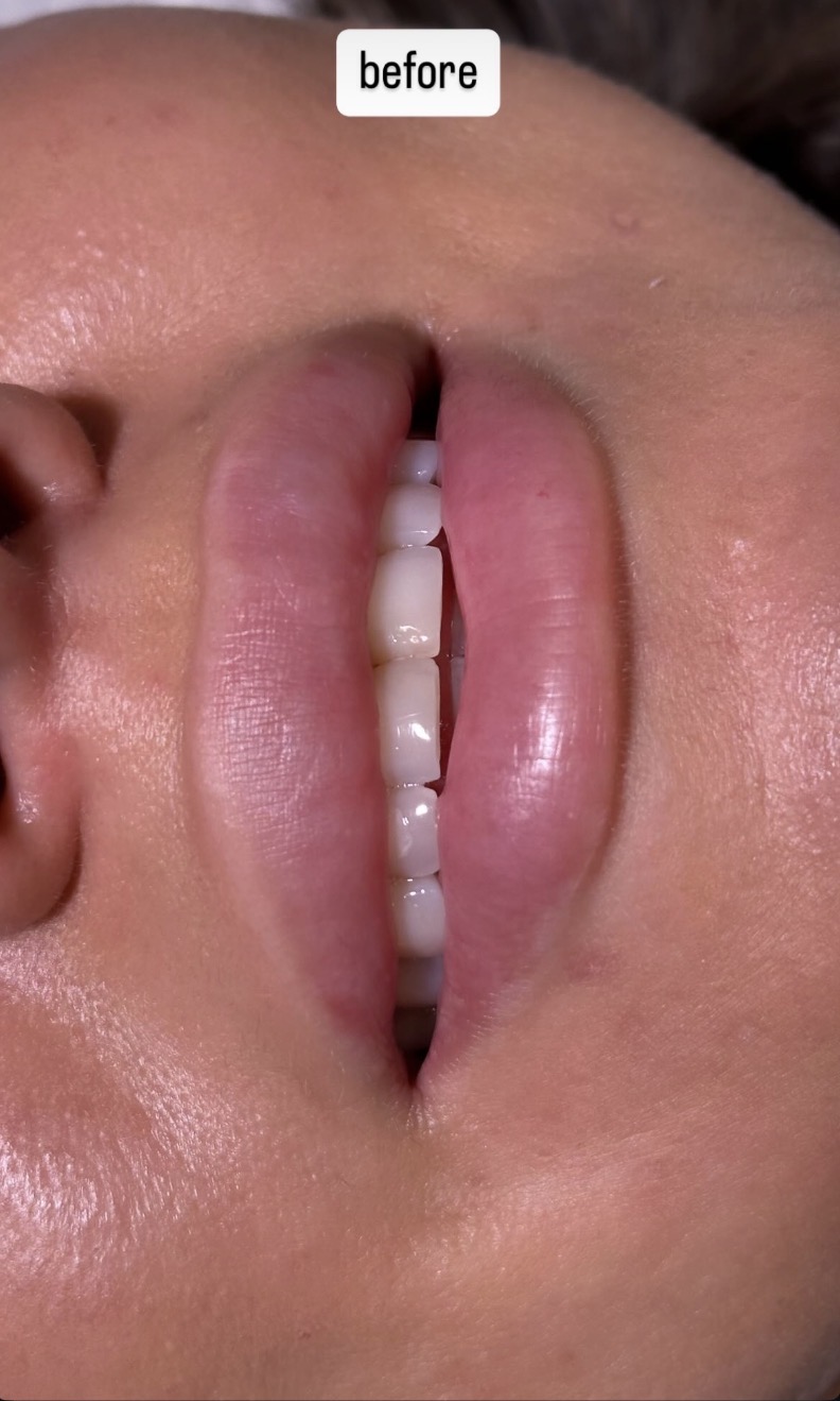 Lips before permanent make-up